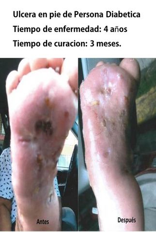 Ulcera