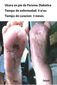 Ulcera