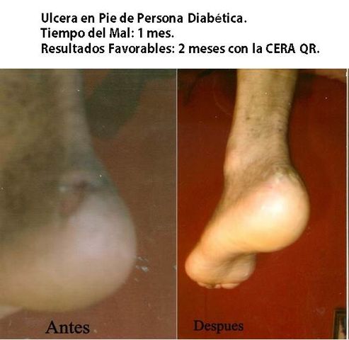 Ulcera