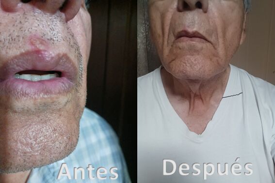 HERPES 1
DESPUES DE APLICAR CERA QR POR 8 DIAS SE DESVANECIO NOTABLEMENTE