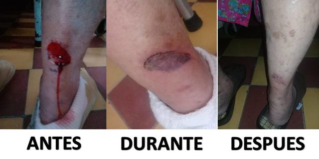 Ulcera en Persona de mas de 90 años.
Tiempo de Curacion: 18 dias